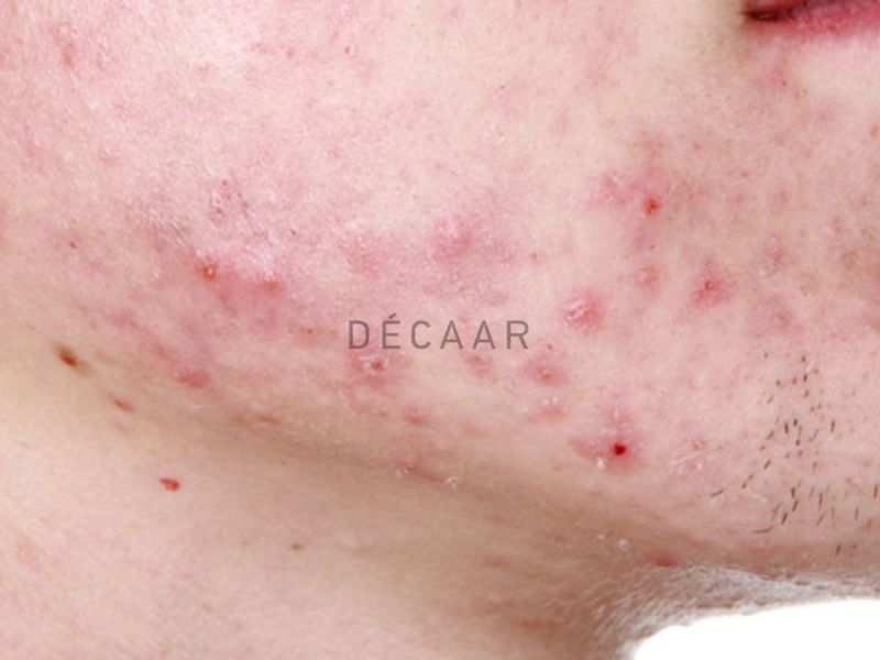 mụn trứng cá bọc